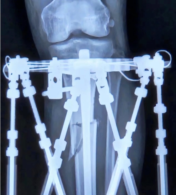 29岁小伙花十几万断骨增高致残，身高焦虑背后的代价，值得我们每个人警惕
